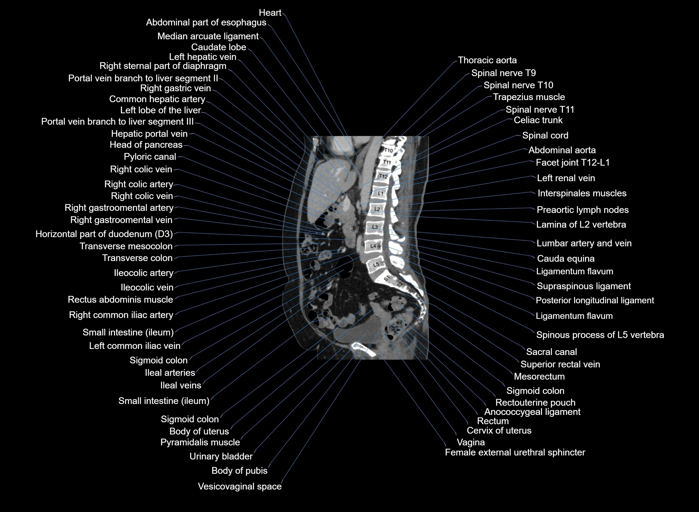 CT Abdomen sagittal cross sectional anatomy labelled radiology image -00060.webp